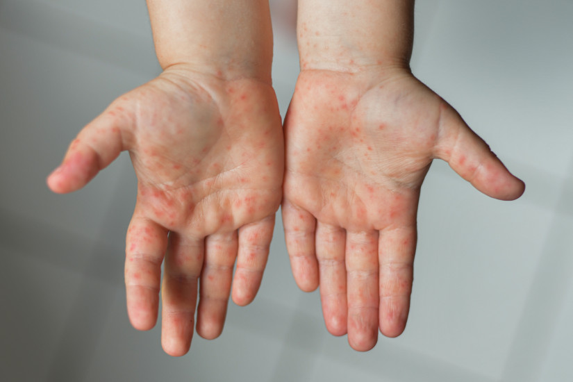 A kéz-láb-száj betegség tünetei