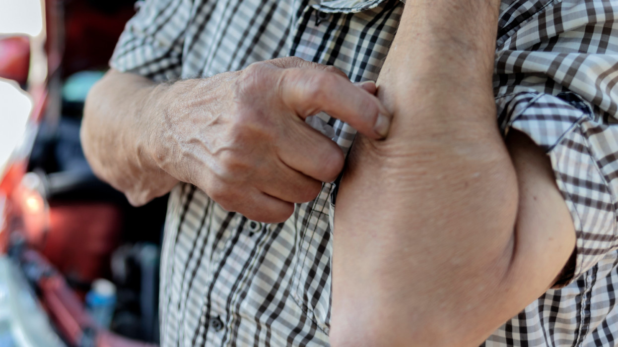 Cropped shot of an insect bite on arm of a senior man. Irritated Caucasian male person with redness on his arm from an insect bite at the park on a summer day. He looks in pain and scratching.
