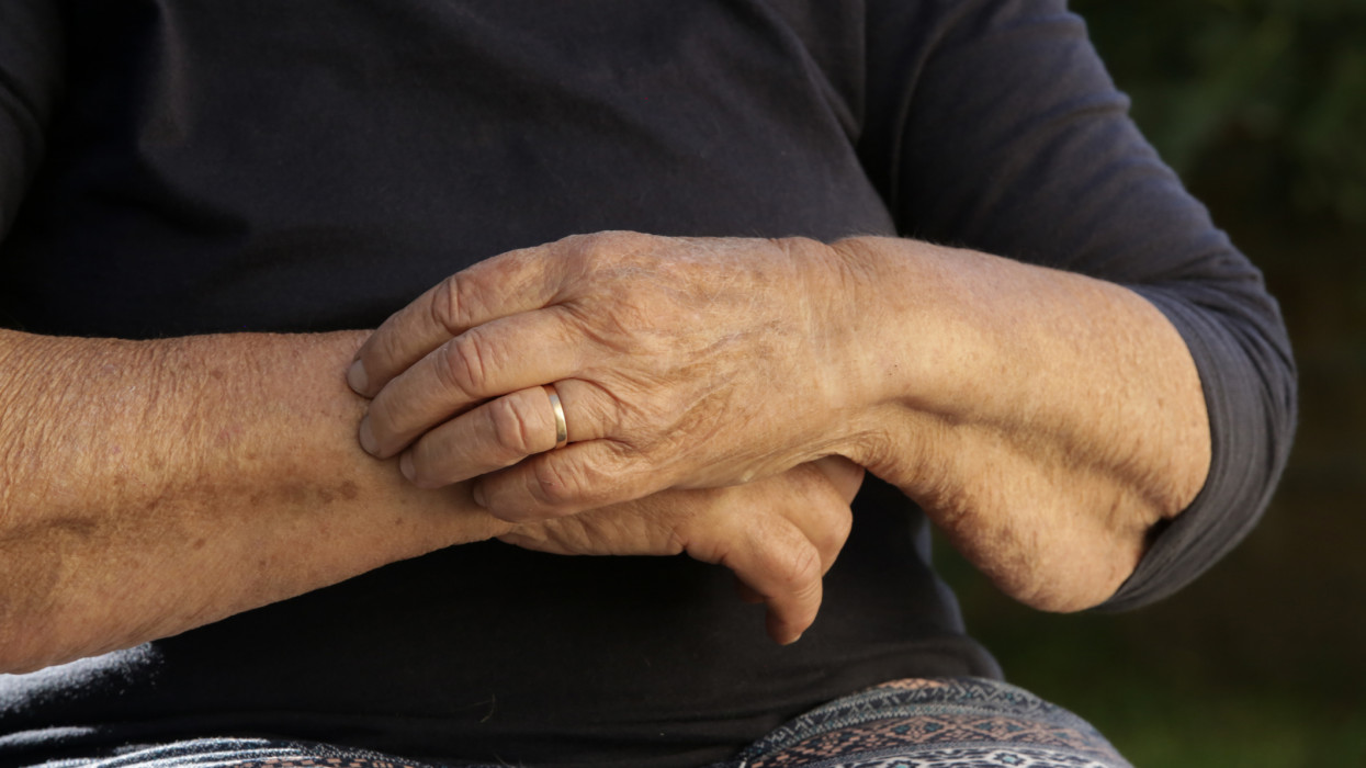 Elderly caucasian woman scratching dry skin on her arm. Senior dry skin problem.