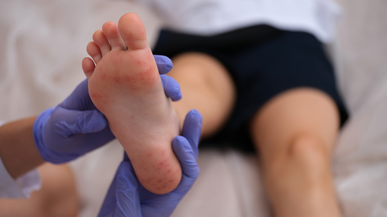 Infectious disease doctor examining rash on skin of child feet closeup. ÃÂ¡oxsackie virus symptoms hand-foot-mouth concept
