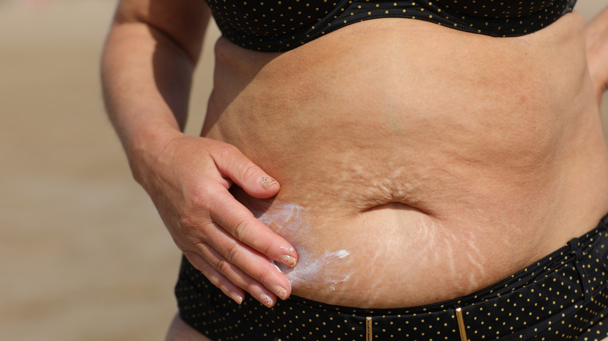 overweight woman applying sunscreen lotion on her belly with stretch marks, close up detail. High quality photo.
