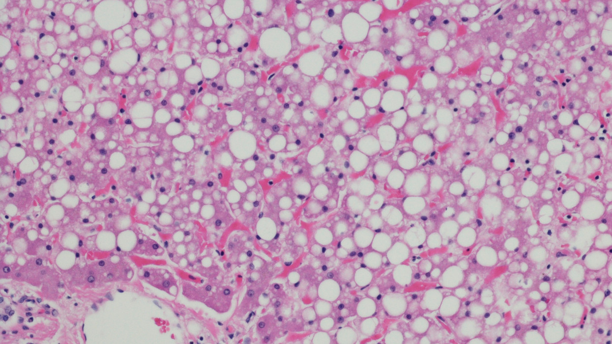 Microscopic photo of a professionally prepared slide demonstrating macrovesicular steatosis of the liver (fatty liver disease), hepatic steatosis, metabolic syndrome.  Can be ssociated with nonalcoholic fatty liver disease (NAFLD) or Alcoholic Liver Disease (ALD).  H&E stain.