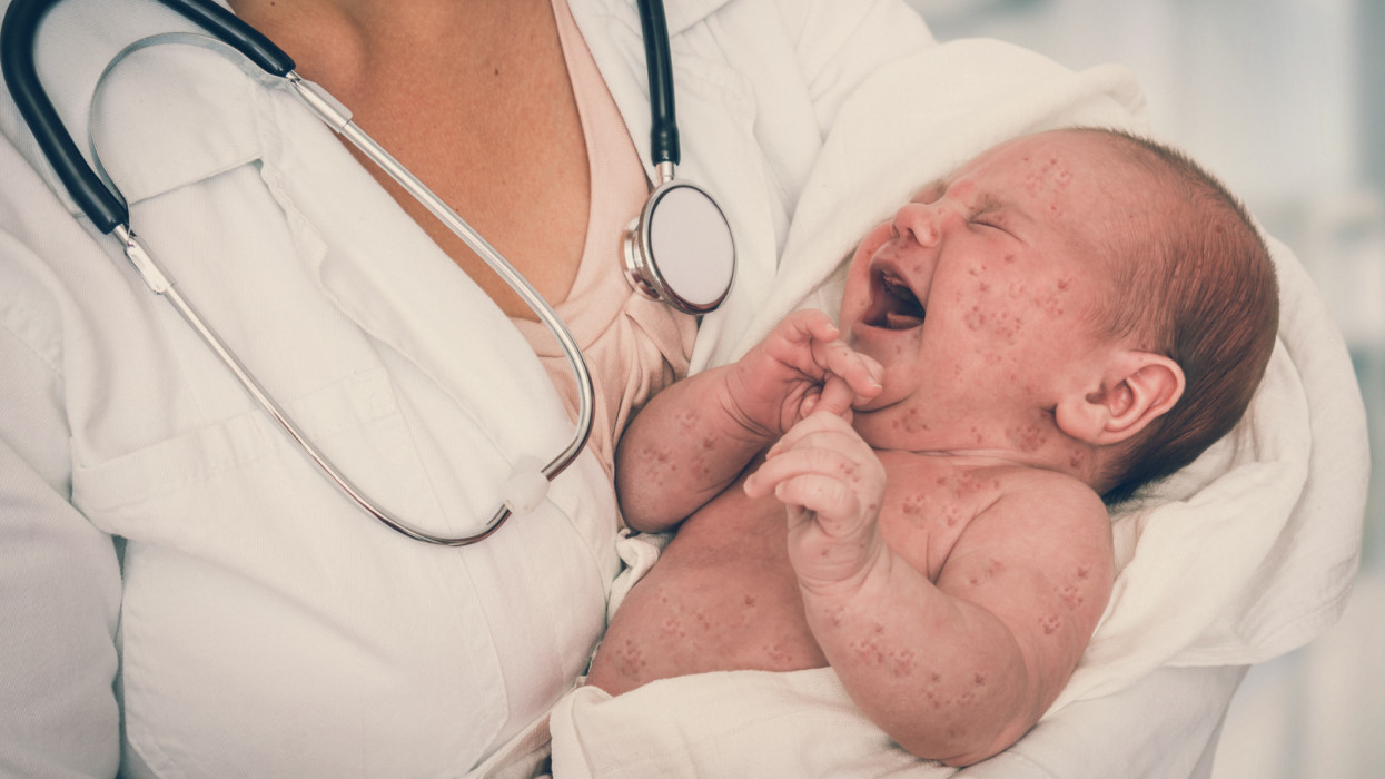 Doctor with stethoscope holding a newborn baby which is sick rubella or measles
