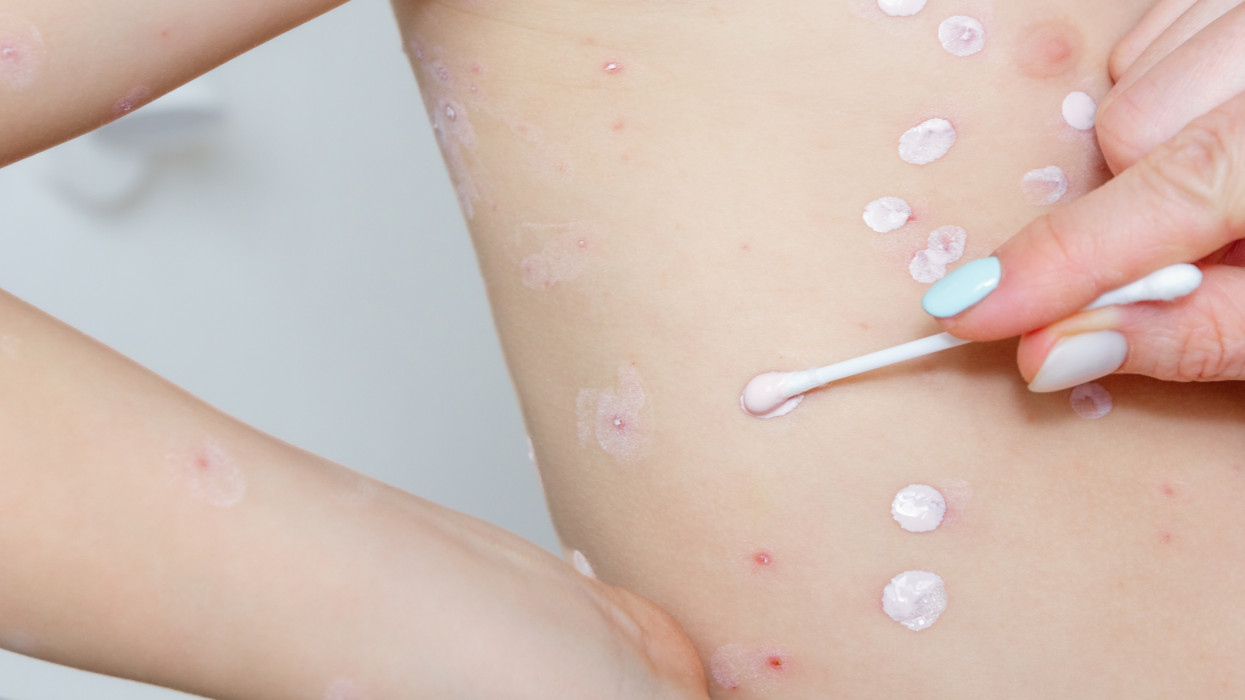 Chickenpox treatment - applying moisturizer to skin with pox in a child. Pediatric dermatology, skin condition, smallpox virus, skin care, antiseptic cream.