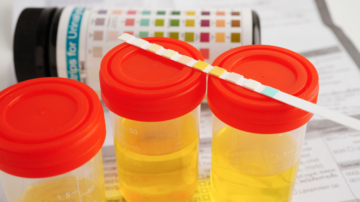 Urinalysis, pregnancy test and urine cup for female of ovulation day, fetus, maternity, childbirth, birth control.